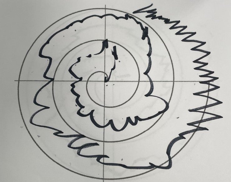 While in the OR, patients are asked to draw a spiral before and after deep-brain stimulation. This was drawn by a patient before undergoing the procedure.